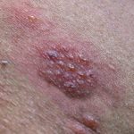Shingles