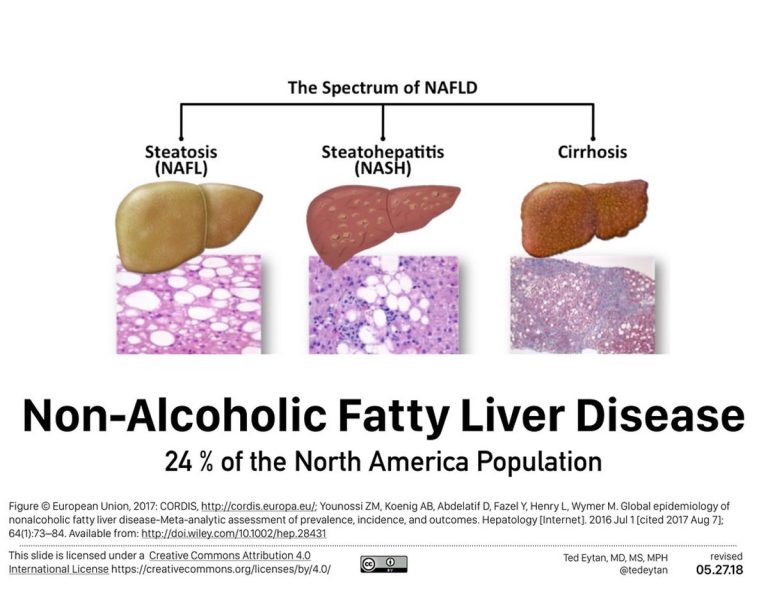 Non Alcoholic Fatty Liver Disease( NAFLD) A Silent and Serious Epidemic Premier Health Associates